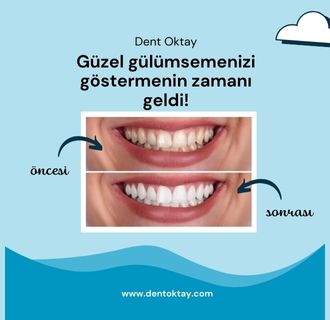 öncesi sonrası diş beyazlatma