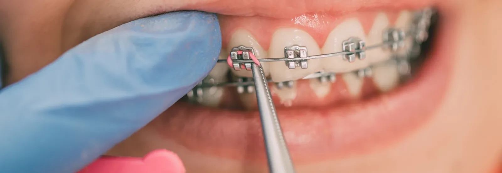 Ortodonti / Diş Teli Tedavisi