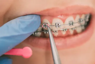 Ortodonti / Diş Teli Tedavisi