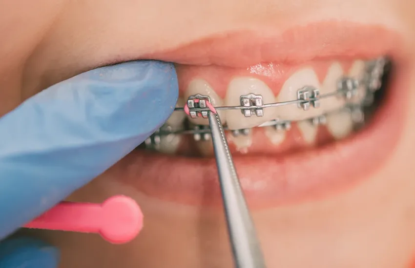 Ortodonti / Diş Teli Tedavisi